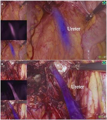 Initial experience of ureteric visualization using methylene blue during laparoscopy for gynecological surgery